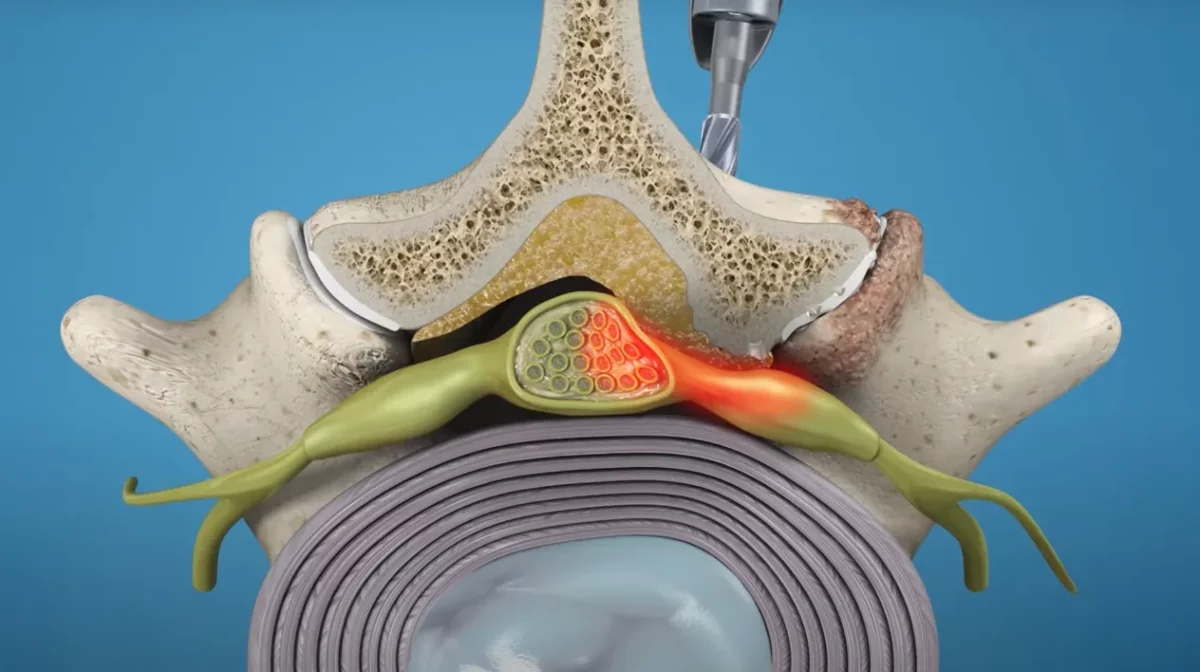 Endoscopic Laminectomy