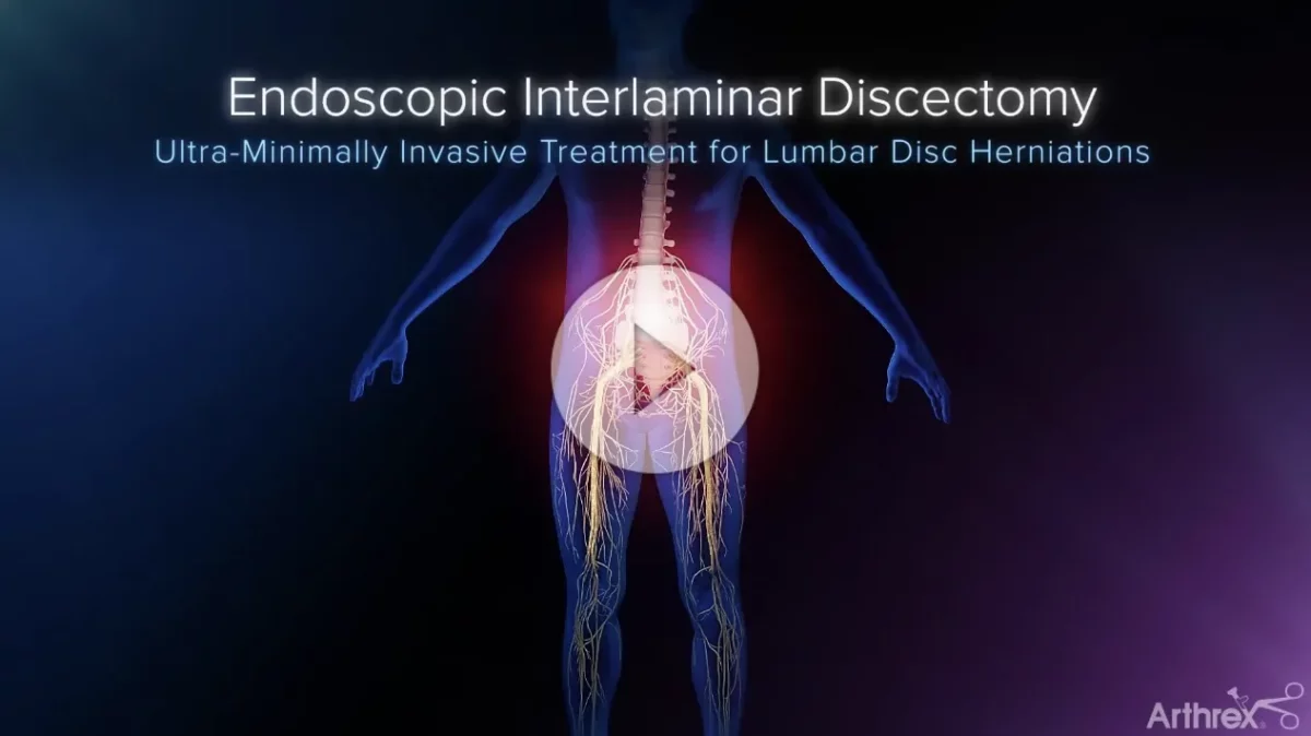 Endoscopic Discectomy
